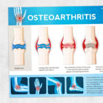 Physical and occupational therapy printable handout: Osteoarthritis