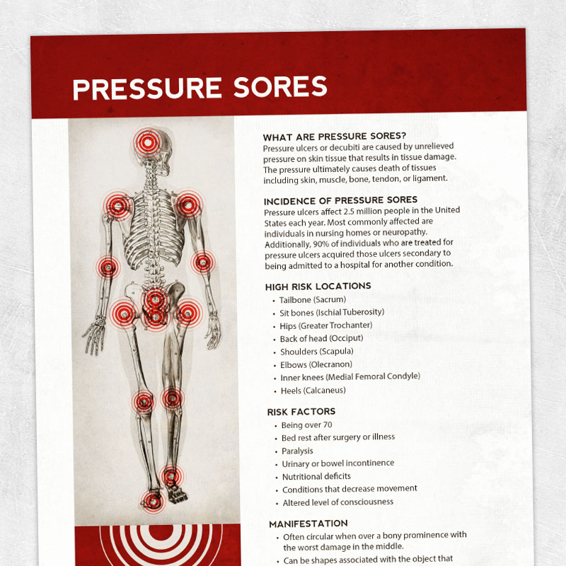 Physical therapy printable handout: Pressure sores