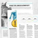 Physical and occupational therapy printable handout: Reverse total shoulder arthroplasty