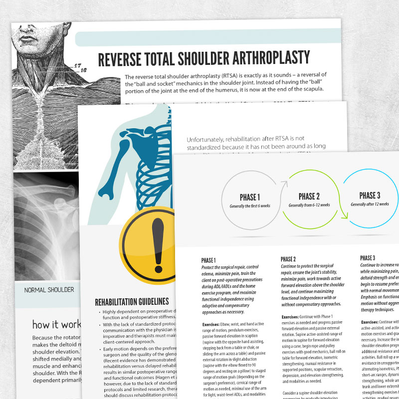 Physical and occupational therapy printable handout: Reverse total shoulder arthroplasty