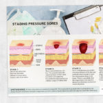 Physical and occupational therapy printable handout: Staging pressure sores