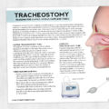 Med SLP printable handout: Tracheostomy