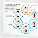 Speech therapy printable handout: Types of cleft lip/palate