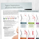 Physical therapy printable: Typical presentations of cervical radiculopathy