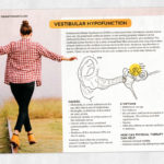 Physical therapy printable handout: Vestibular hypofunction