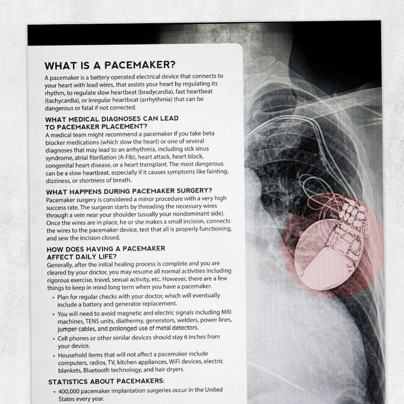 Physical and occupational therapy printable handout: What is a pacemaker?