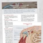 Physical therapy printable handout: What is acromioclavicular joint sprain?