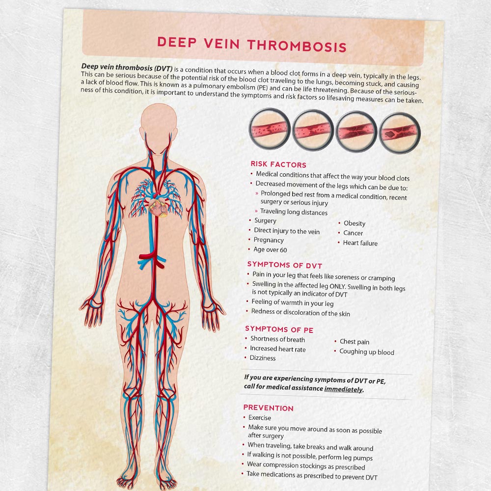 Physical and occupational therapy printable handout: Deep vein thrombosis