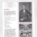 Occupational therapy and physical therapy handout: Ptosis