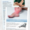 Physical therapy handout: What is tibialis posterior tendinopathy
